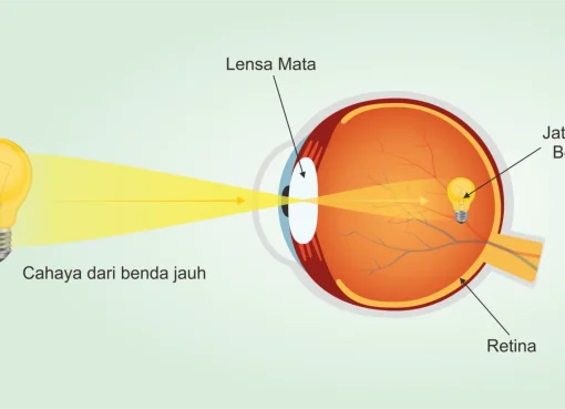 Rabun Jauh Yang Bikin Repot? Ini Penyebab, Solusi, dan Cara Pencegahannya Rabun Jauh