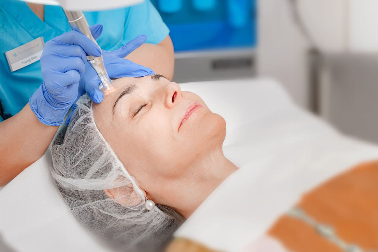 Mikroneedling Treatment