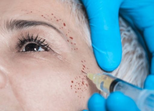 Mikroneedling Treatment: Rahasia Kulit Sehat dan Bercahaya yang Semakin Populer Mikroneedling Treatment