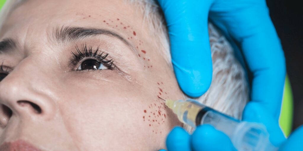 Mikroneedling Treatment