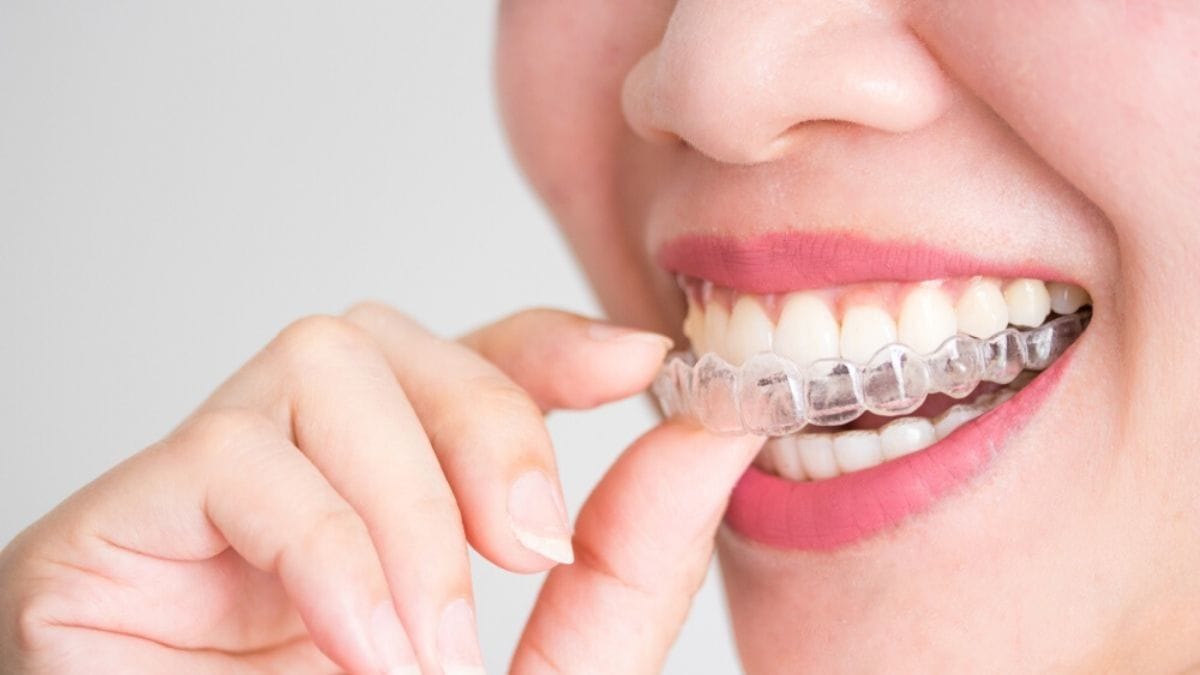 Aligner Transparan