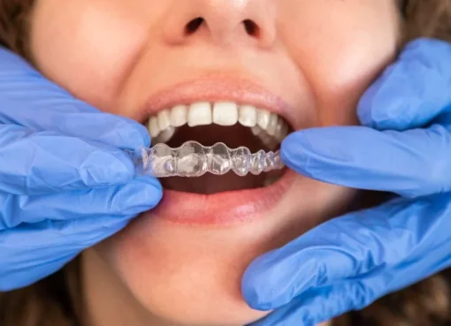 Aligner Transparan