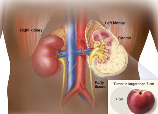 Mengenal Kanker Ginjal